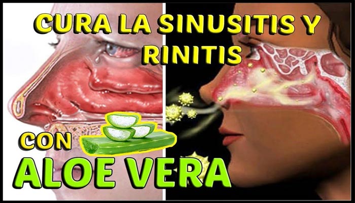 CÓmo Curar La Sinusitis Y Rinitis AlÉrgica Con Aloe Vera Infovirales